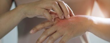 what is eczema