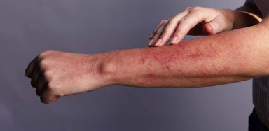 A red rash on a person's forearm.