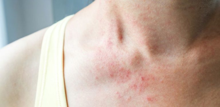 A skin rash on a person's chest