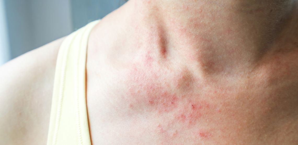 Hidradenitis Suppurativa Symptoms Common Signs And Risk Factors